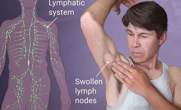 Hodgkin’s-Lymphoma